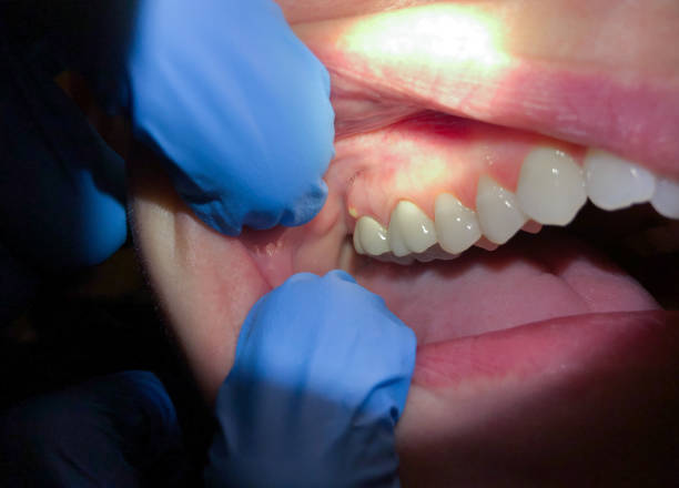 Best Emergency Dental Care for Abscessed Tooth in Dunnigan, CA